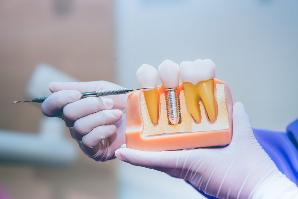 Dental Implants in Chicago